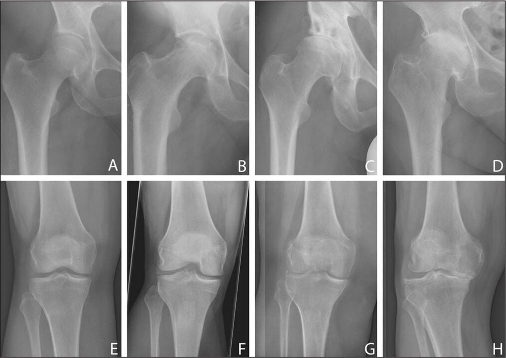 Artrosi dell'articolazione dell'anca in dinamica