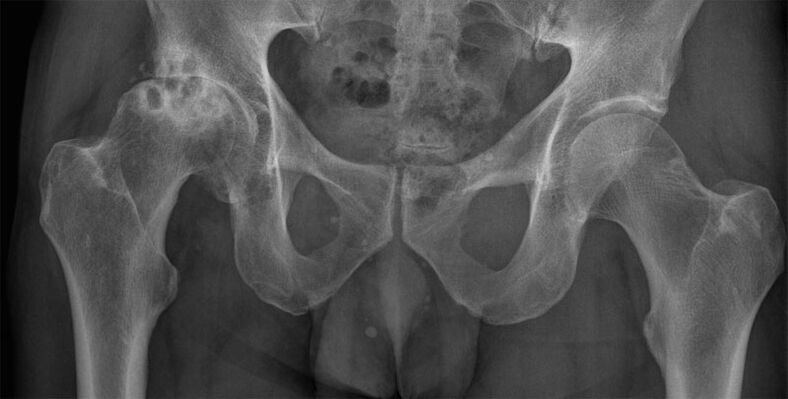 Artrosi di stadio 3 dell'articolazione dell'anca alla radiografia