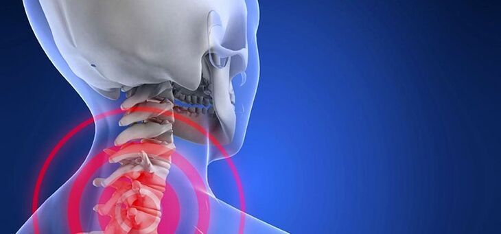 Osteocondrosi della regione cervicale