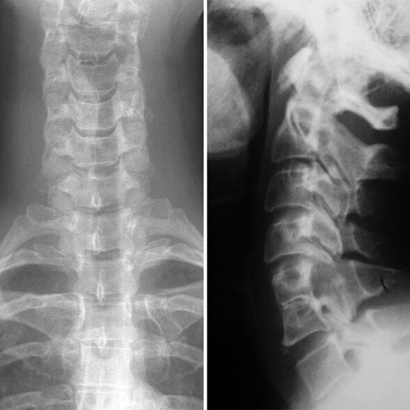 X -raggio della colonna cervicale