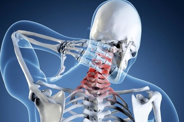 Osteocondrosi della regione cervicale