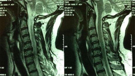 MRI del dipartimento cervicale