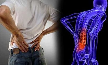 Le ragioni dello sviluppo dell'osteocondosi lombare