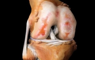 cos'è l'artrosi dell'articolazione del ginocchio
