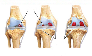 fasi dell'artrosi del ginocchio