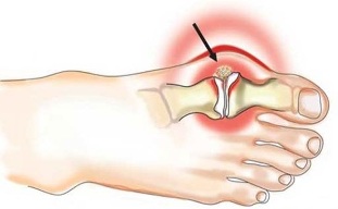 Infiammazione dell'articolazione tra il pollice e il piede nell'artrite
