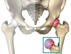 cause di atrosi dell'articolazione dell'anca