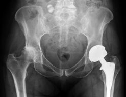 diagnosi di artrosi dell'articolazione dell'anca