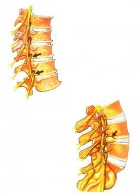 illustrazione dell'osteocondrosi della colonna vertebrale