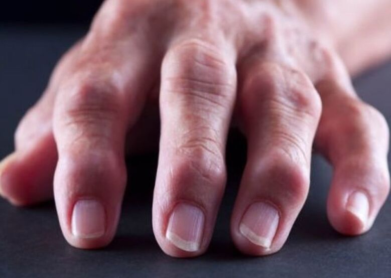 artrite reumatoide come causa di dolore alle articolazioni delle dita