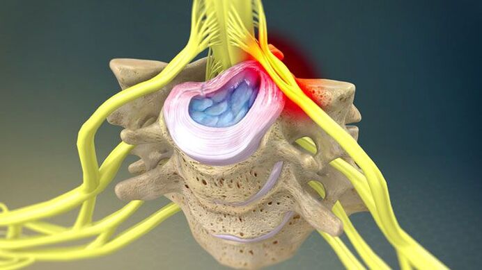 La protrusione del disco intervertebrale è la causa del dolore al collo