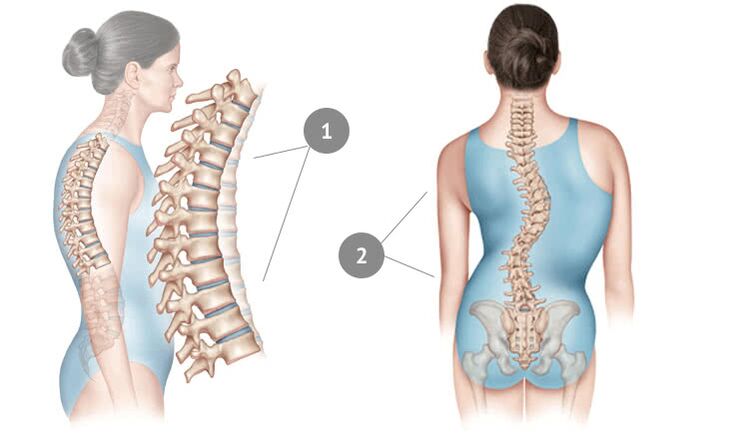 curvatura della colonna vertebrale come causa di osteocondrosi toracica