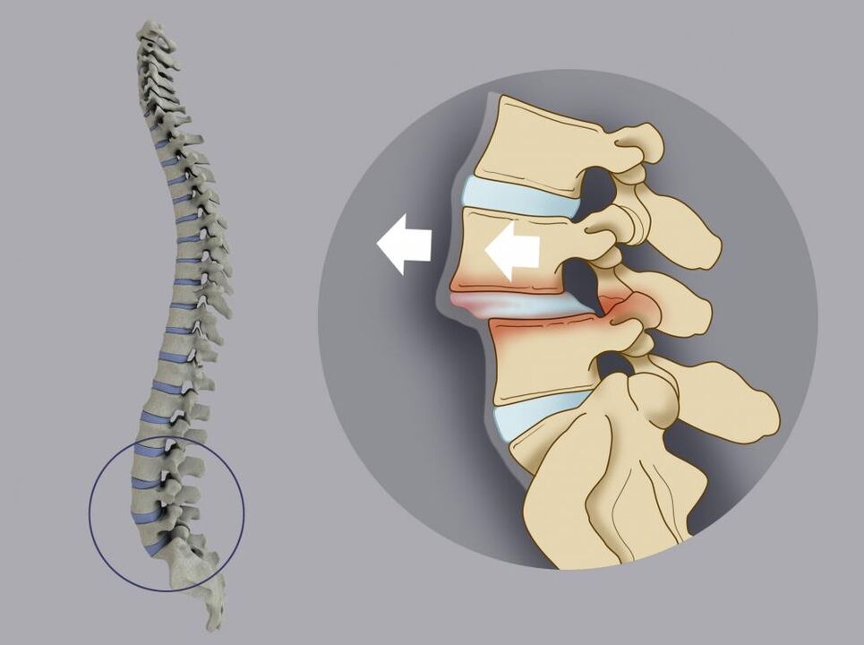 spostamento delle vertebre come causa di mal di schiena