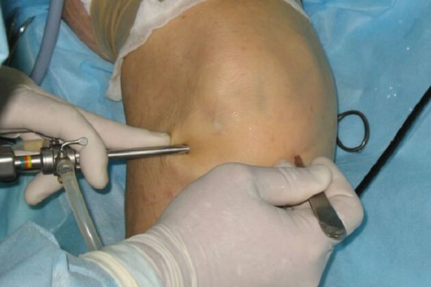 artroscopia per dolore al ginocchio